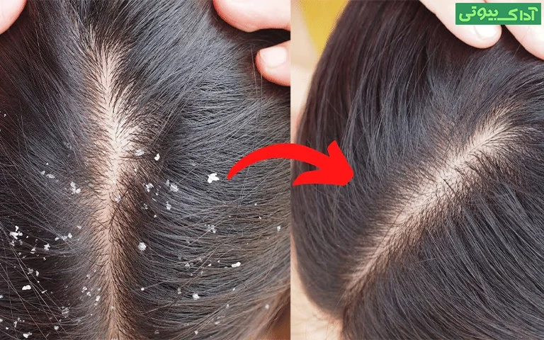 ضد شوره و ضد میکروب