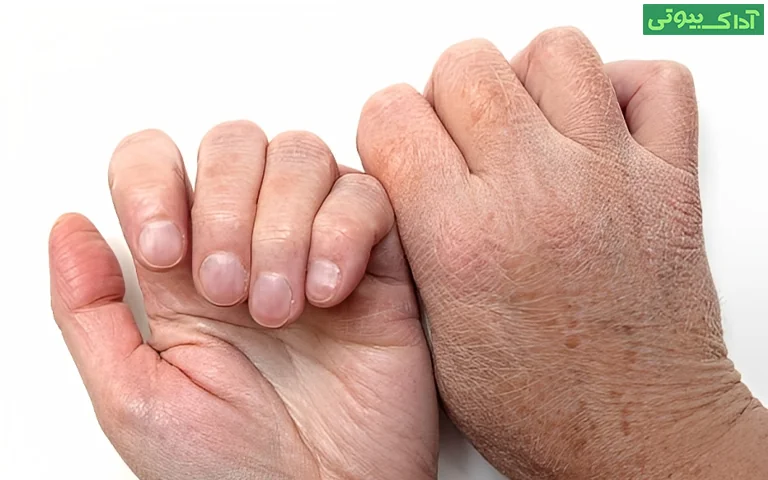 ترک دست چگونه شکل می گیرد؟