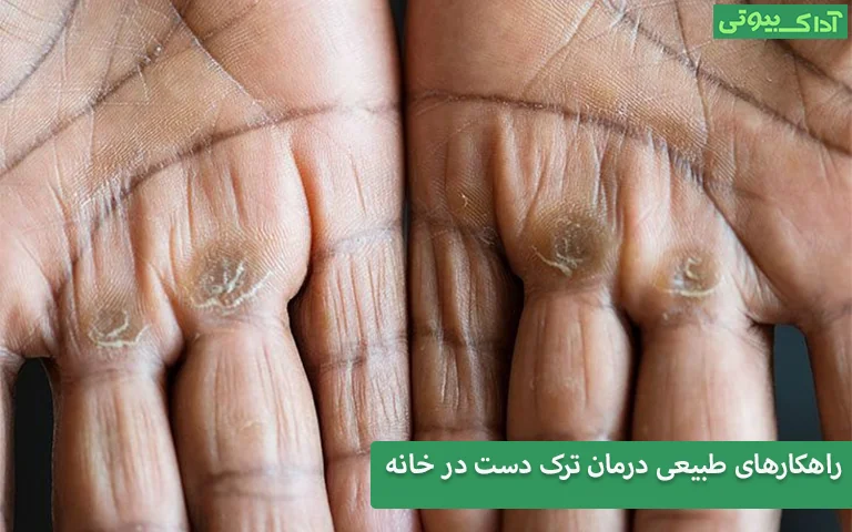 راهکارهای طبیعی درمان ترک دست در خانه