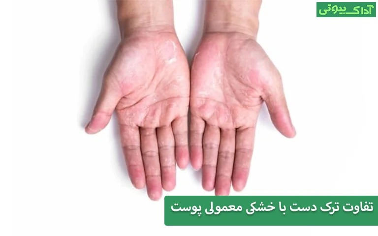 تفاوت ترک دست با خشکی معمولی پوست